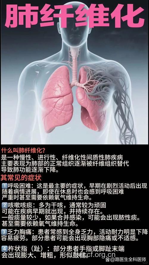 肺纤维化常见的5种症状