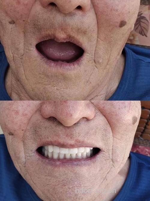 老人带假牙睡觉容易患肺炎