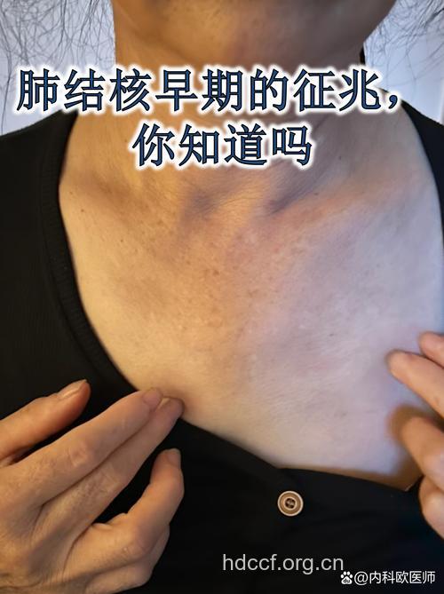 肺结核有哪些早期症状