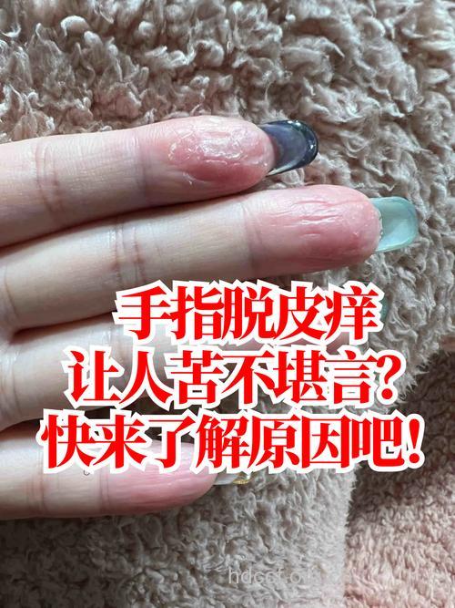 冬天手脱皮怎么办