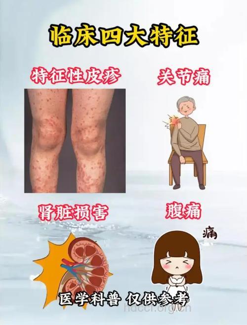 紫癜性肾炎有哪些肾外症状呢