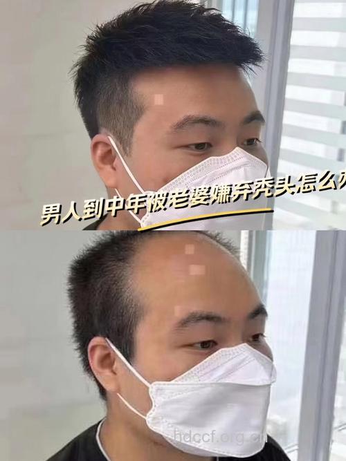 100年内所有成年男人都将成秃头?