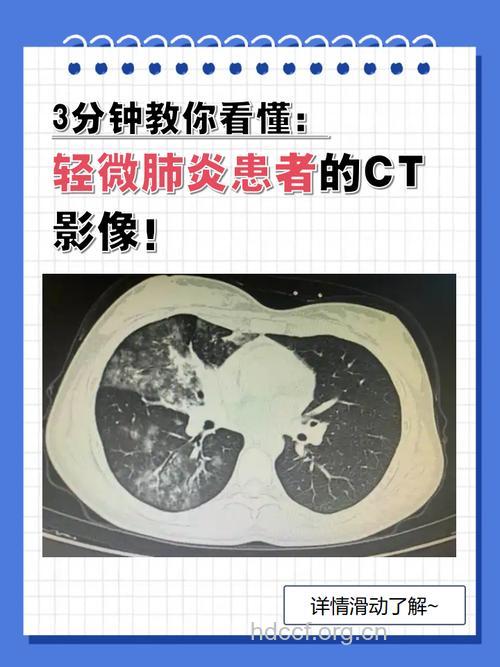 间质性肺炎为什么要进行CT检查