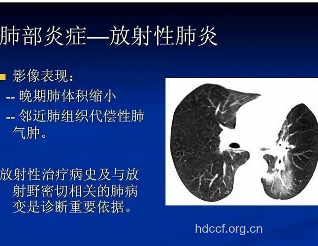 怎么判断放射性肺炎治疗效果