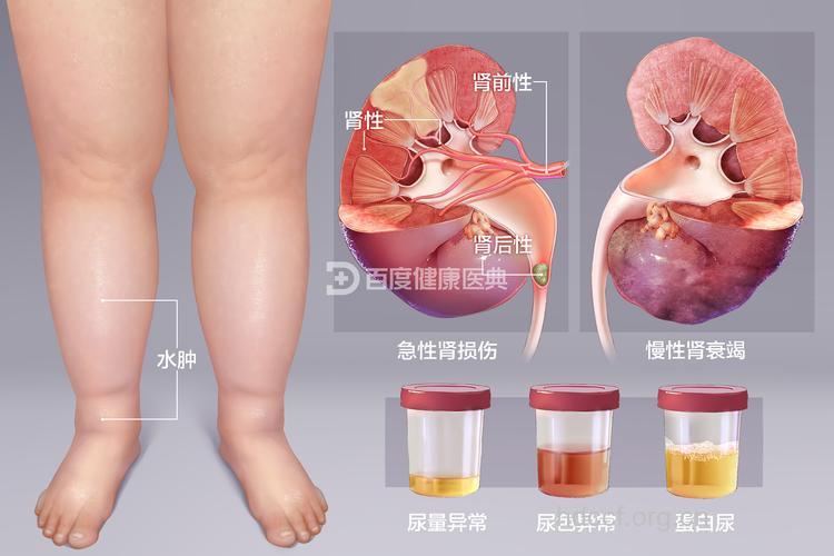 肾炎患者有哪些肾外表现