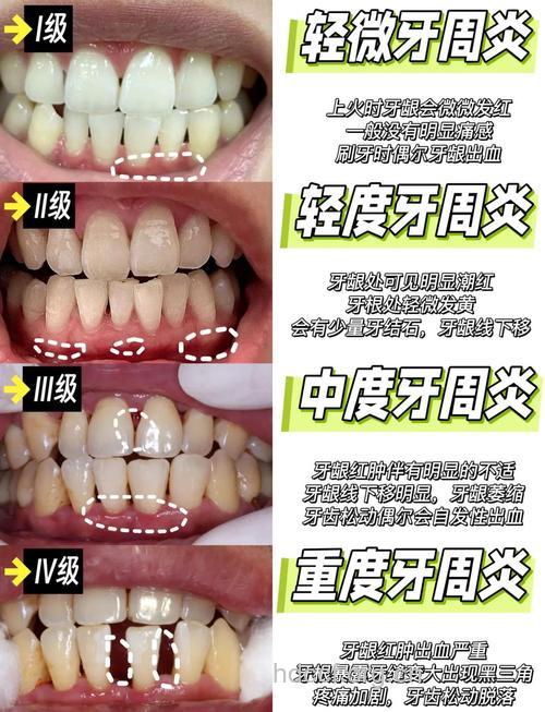 牙缝大会带来哪些疾病