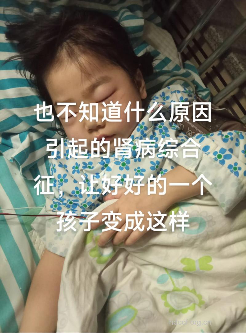 急性肾炎患者能生孩子吗