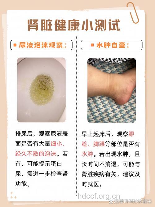关于肾炎有哪些常见误区