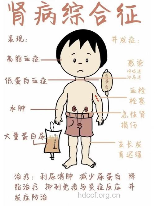 原发性肾病综合征是儿童高发的疾病