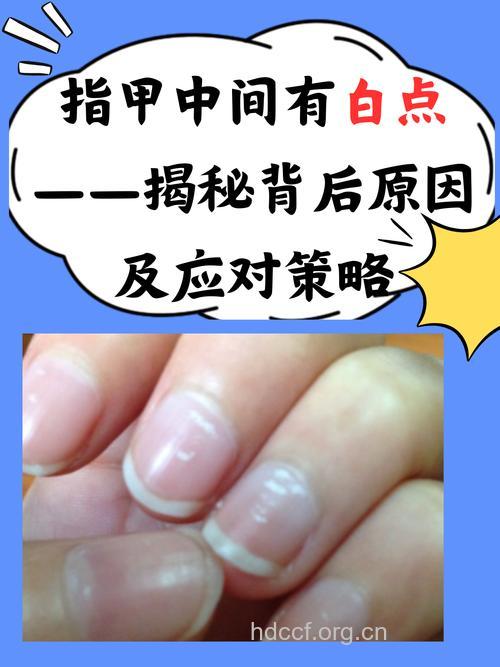 男性肾虚的预兆-指甲白斑
