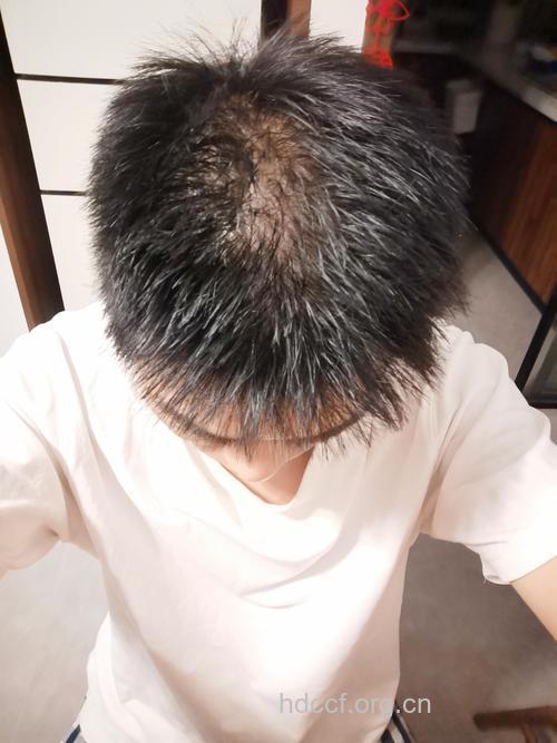 过度健身会导致早脱发