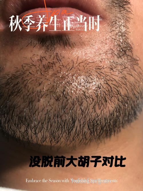 男人没胡须是不是病？