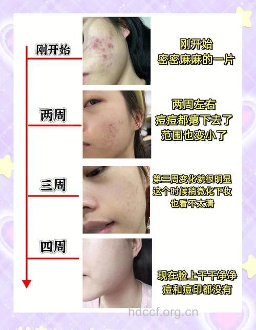 八个去痘印的方法