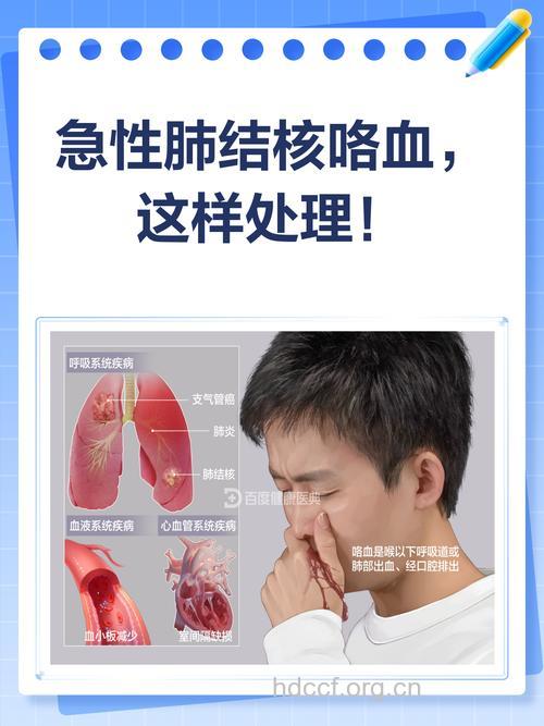 怎么治疗肺结核咯血