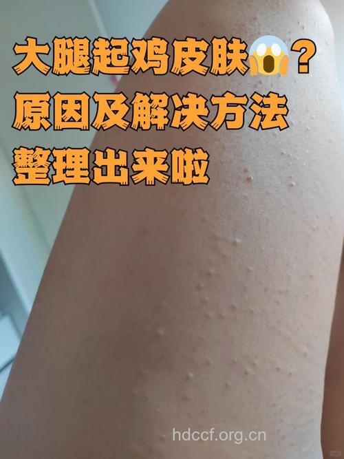 过度清洁皮肤易导致鸡皮肤