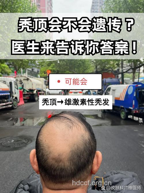 秃顶遗传吗 听专家详解