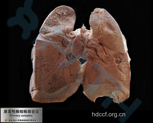 什么是原发性肺结核?