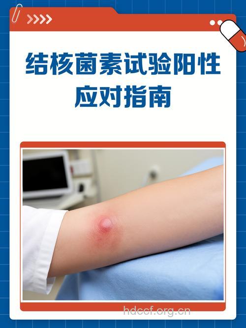 结核菌素试验阳性是否患上了肺结核