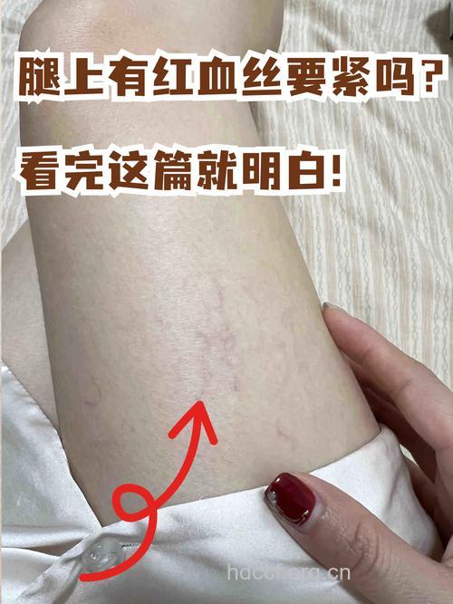 腿部出现红血丝是怎么回事?原因大盘点