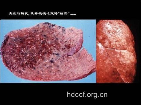 卡氏肺囊虫肺炎如何治疗