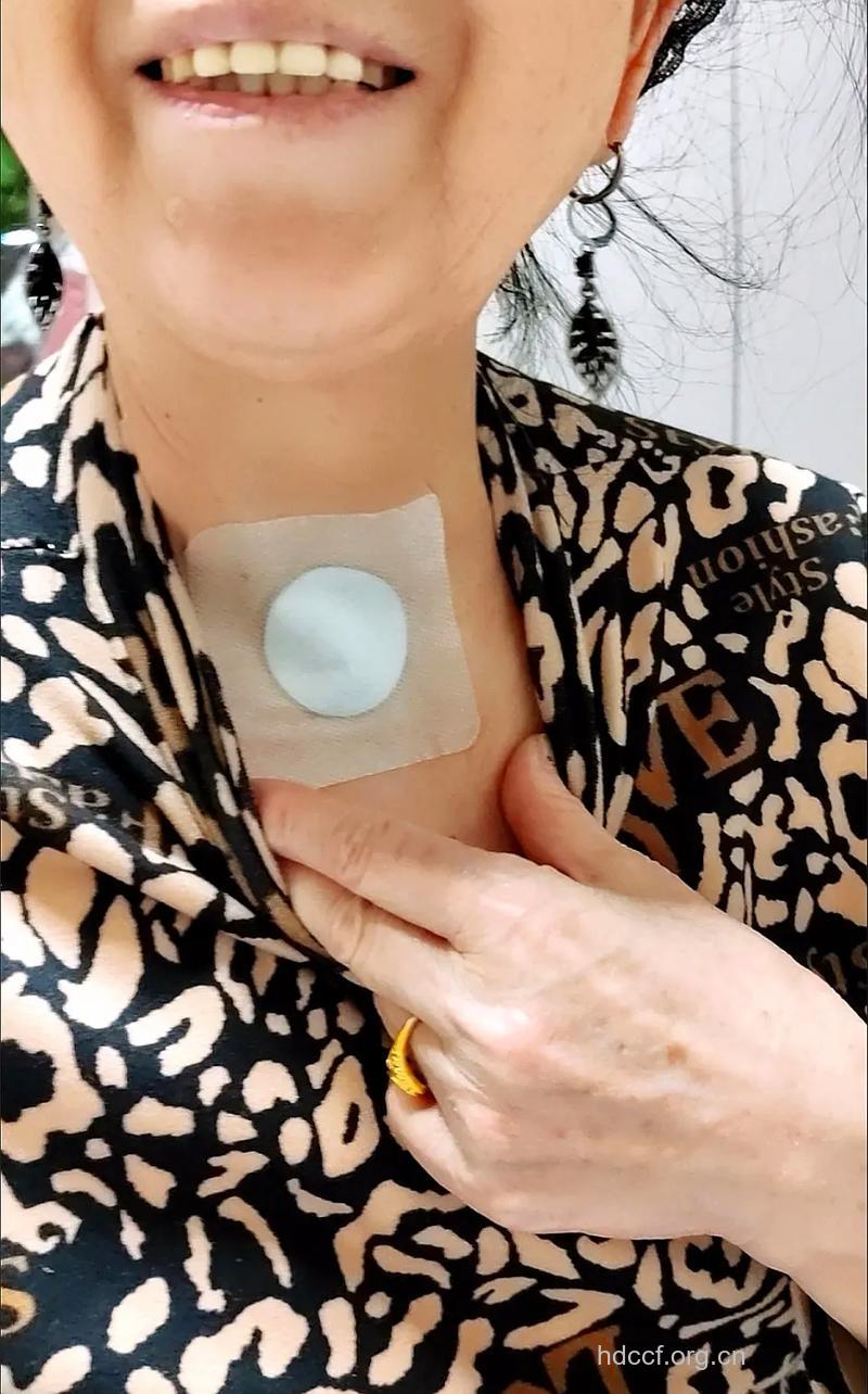 敷贴法治疗气管炎