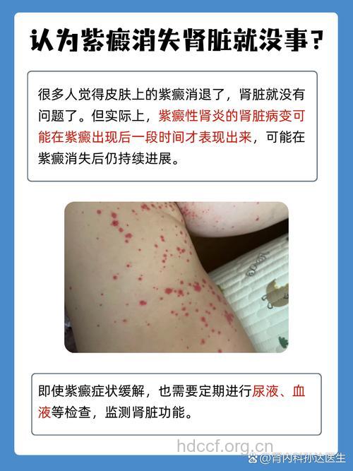什么是紫癜性肾炎