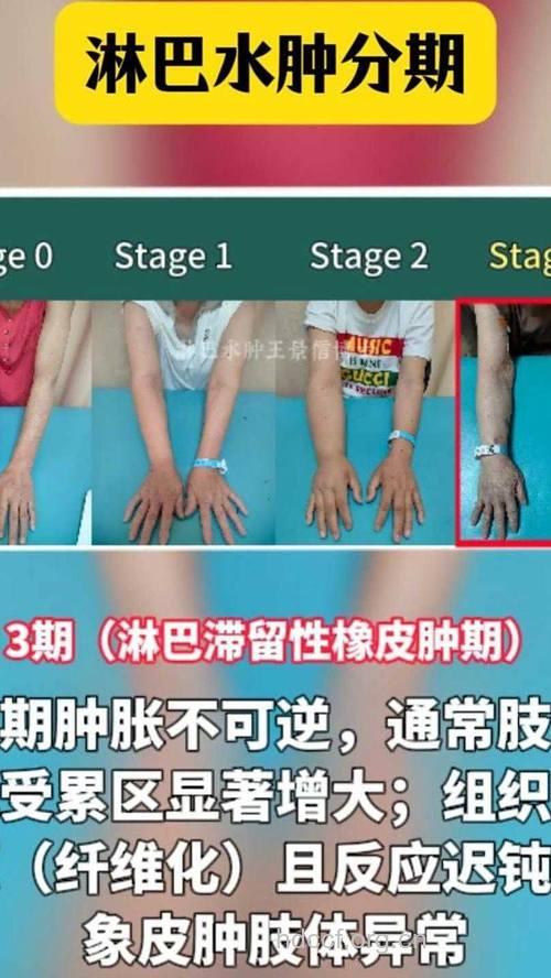 淋巴水肿可分为哪些类型