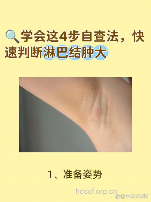 每一期淋巴水肿的特征如何区分