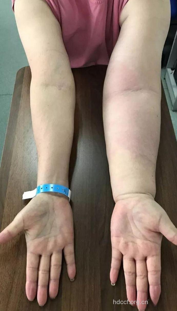 乳腺癌患者出现上肢淋巴水肿是为什么