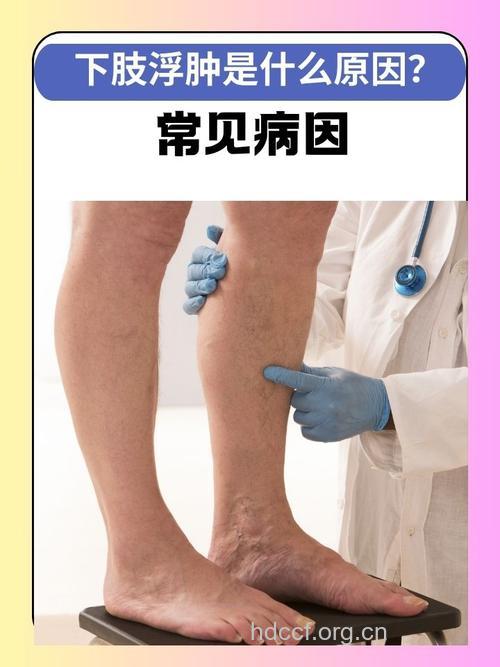 腿异常肿大是不是患了淋巴水肿