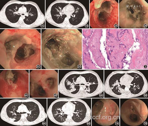 常见的支气管炎症状