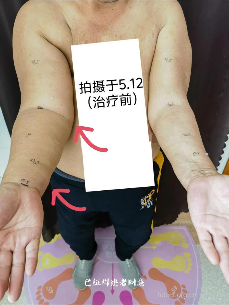 乳癌术后上肢淋巴水肿怎么治疗