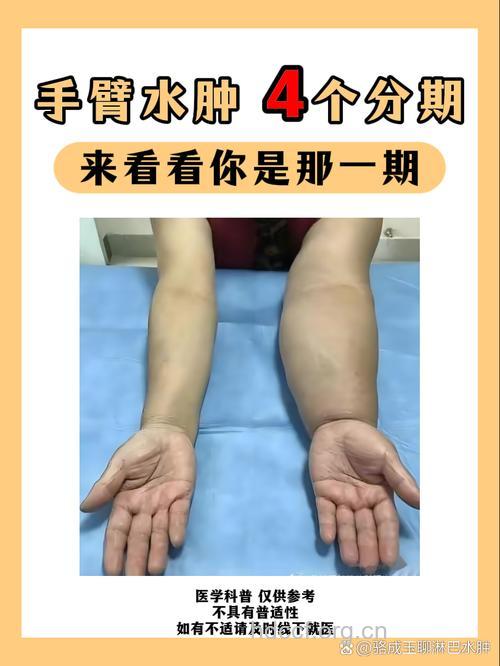 乳腺癌术后上肢淋巴水肿是怎么回事