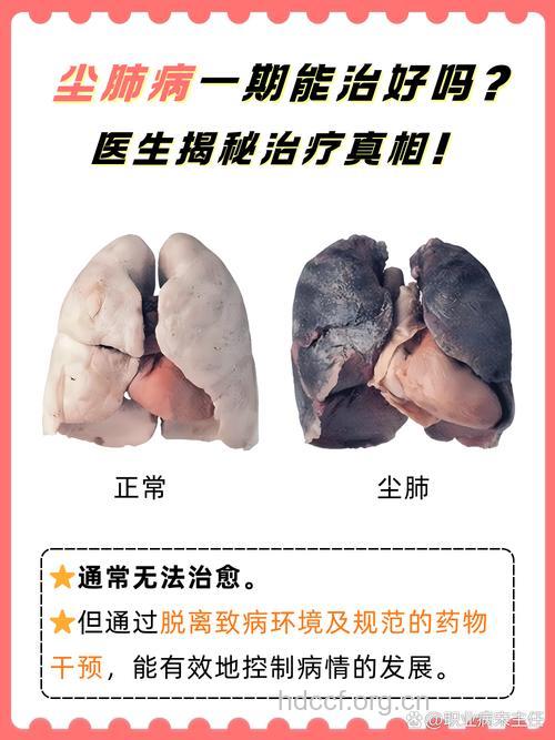 尘肺病的最佳治疗方法