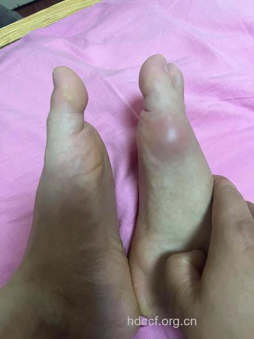 脚部痛风有什么症状