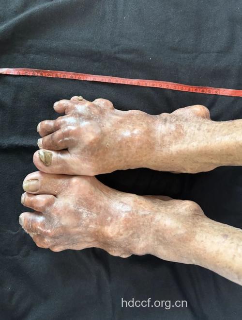 老年人痛风有什么症状特征