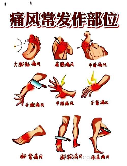 痛风发生在哪些人体部位