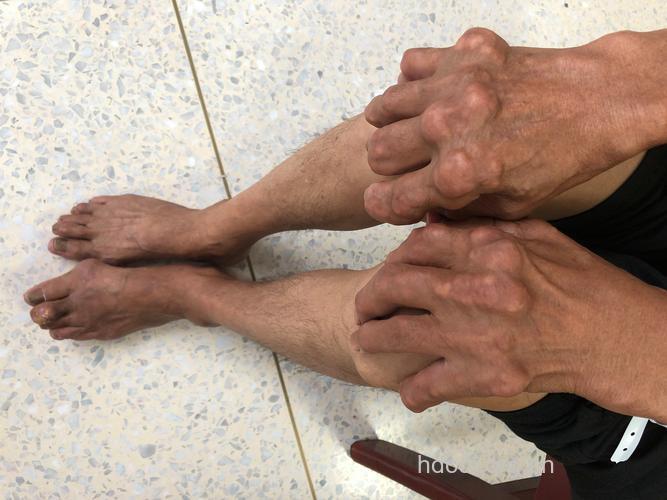 痛风引起肾脏病变的症状