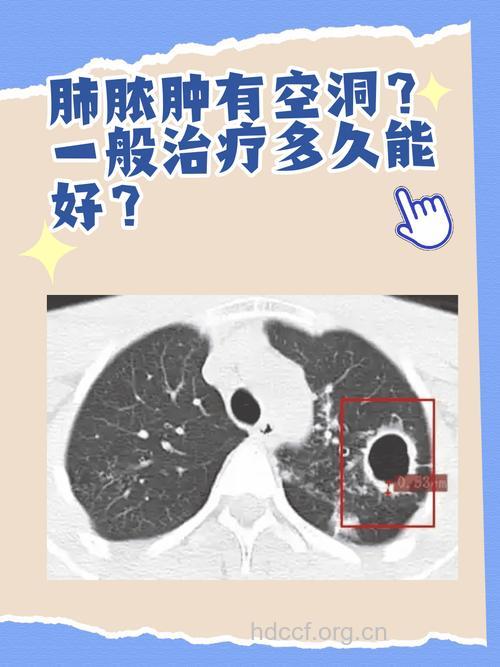 真假肺脓肿大揭秘