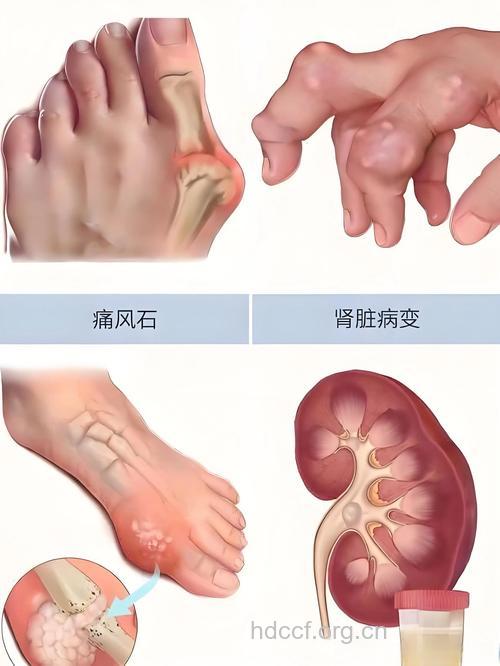 痛风各期的症状