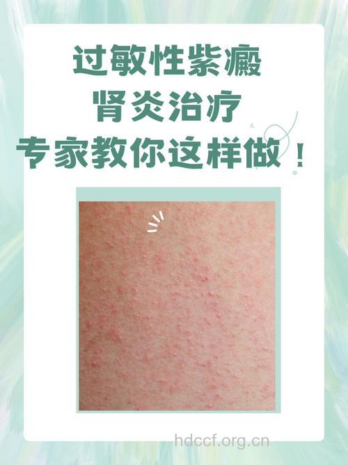 过敏性紫癜肾炎应如何治疗