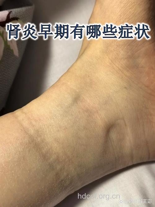 男性慢性肾炎早期的症状