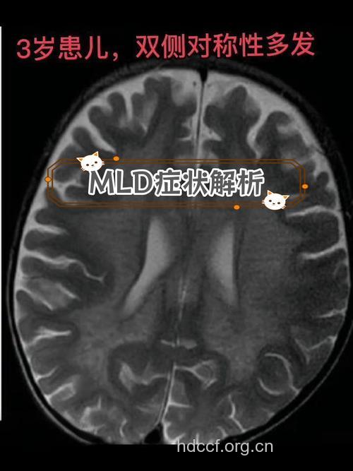 如何诊断Austin型异染性脑白质营养不良？