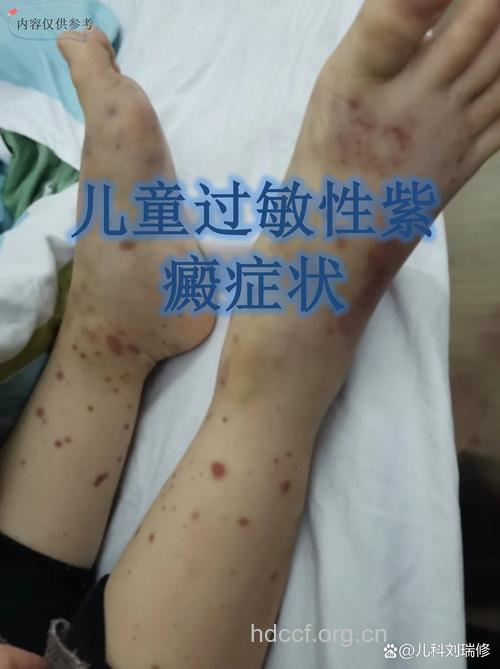 小心儿童紫癜性肾炎