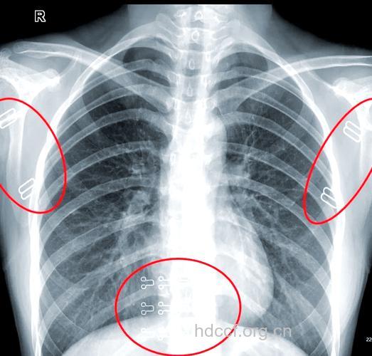 哪些临床疾病常用X线检查
