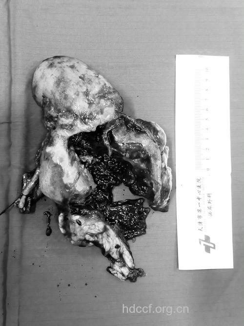 IgA肾病的残酷现实！