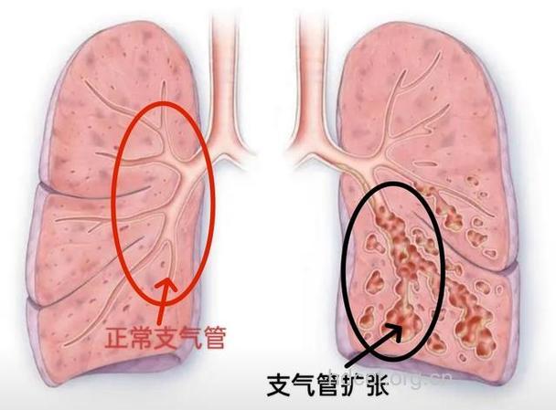 支气管扩张阴虚火旺型