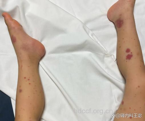 提防:儿童紫癜性肾炎