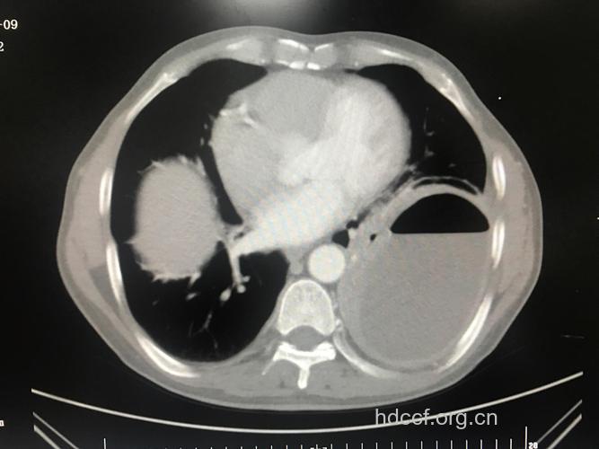 慢性肺脓肿有哪些症状表现