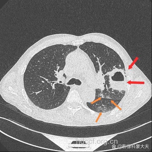 血行性肺脓肿有哪些临床表现
